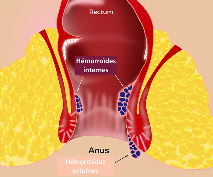 Anus Proctologie - Clinique chirurgie digestive royan