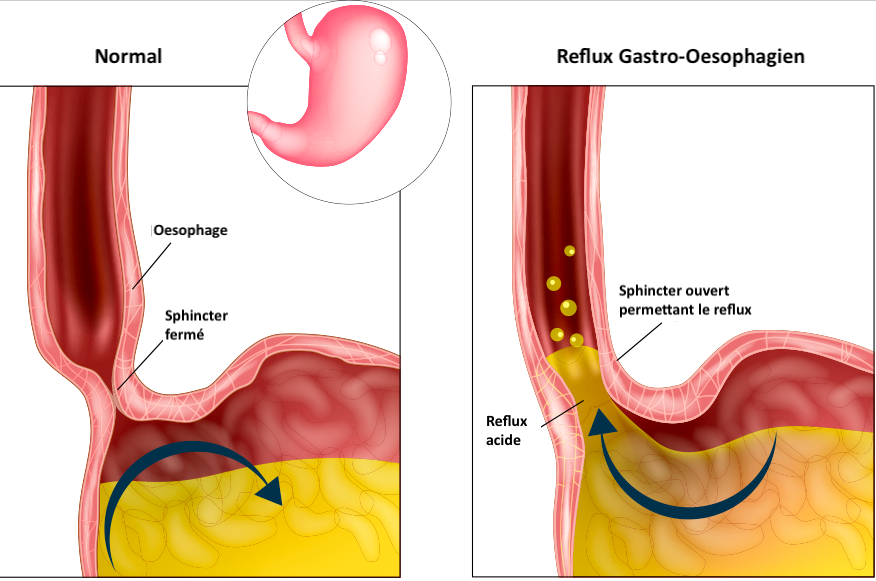 Oesophage - Clinique chirurgie digestive royan