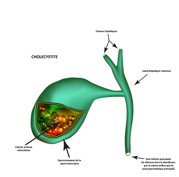 Vesicule Clinique chirurgie digestive royan