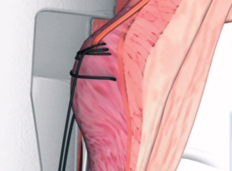 Hemorroides par HAL Doppler Clinique chirurgie digestive royan